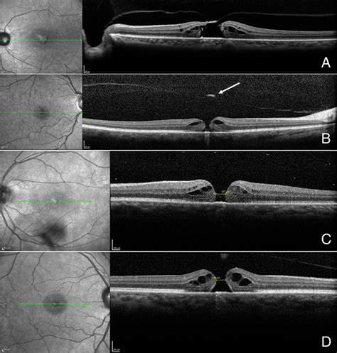 thickness measurement of retina|full thickness retinal hole.